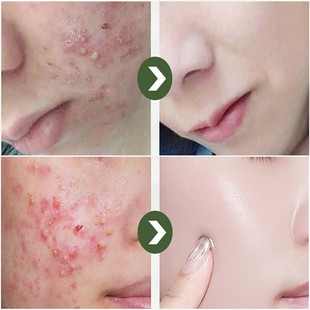 Serum Salicylic Acid Effective Face Removal Anti Acne