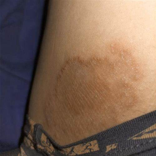 新品大腿根部潮湿瘙痒两侧疙瘩长痘痘股藓大腿根内侧湿疹湿痒真菌