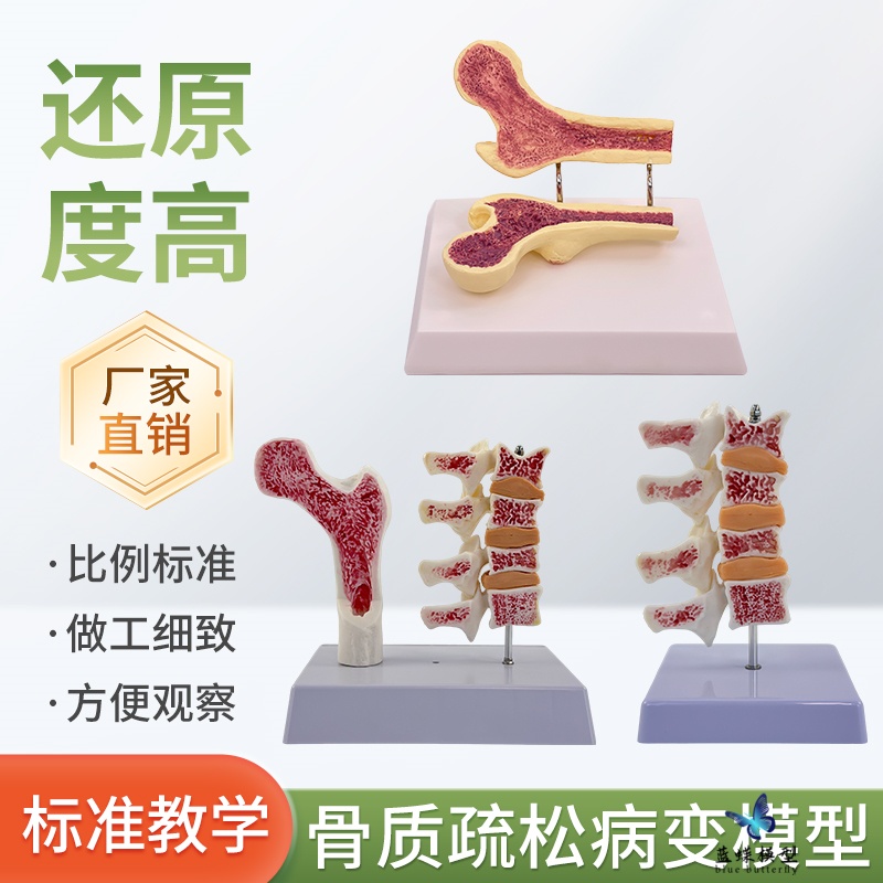 蓝蝶骨质疏松解剖教具