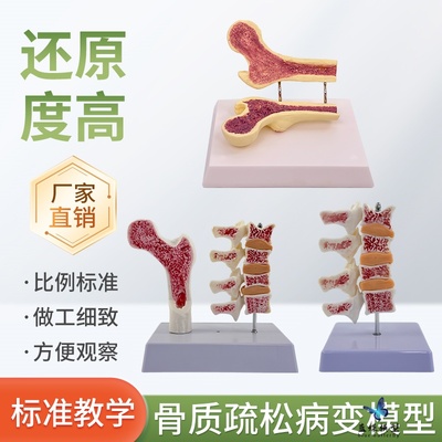 蓝蝶骨质疏松解剖教具