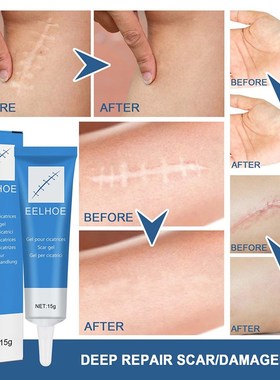 Cicatriz que remove o gel para remover manchas da cicatriz p