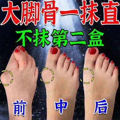 【奇效快】拇外翻大脚骨肿胀痛拇指外翻矫正器脚趾重叠专用药贴YX