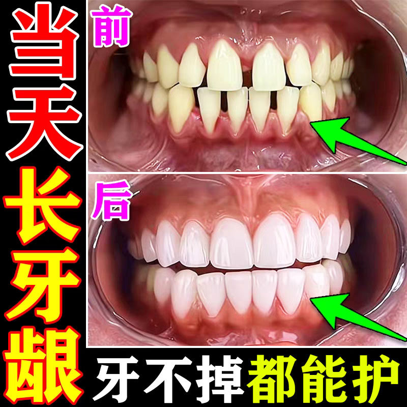 牙龈萎缩松动肿痛消炎抗敏固齿治疗牙周炎脱敏防蛀牙龋齿修复膏YY