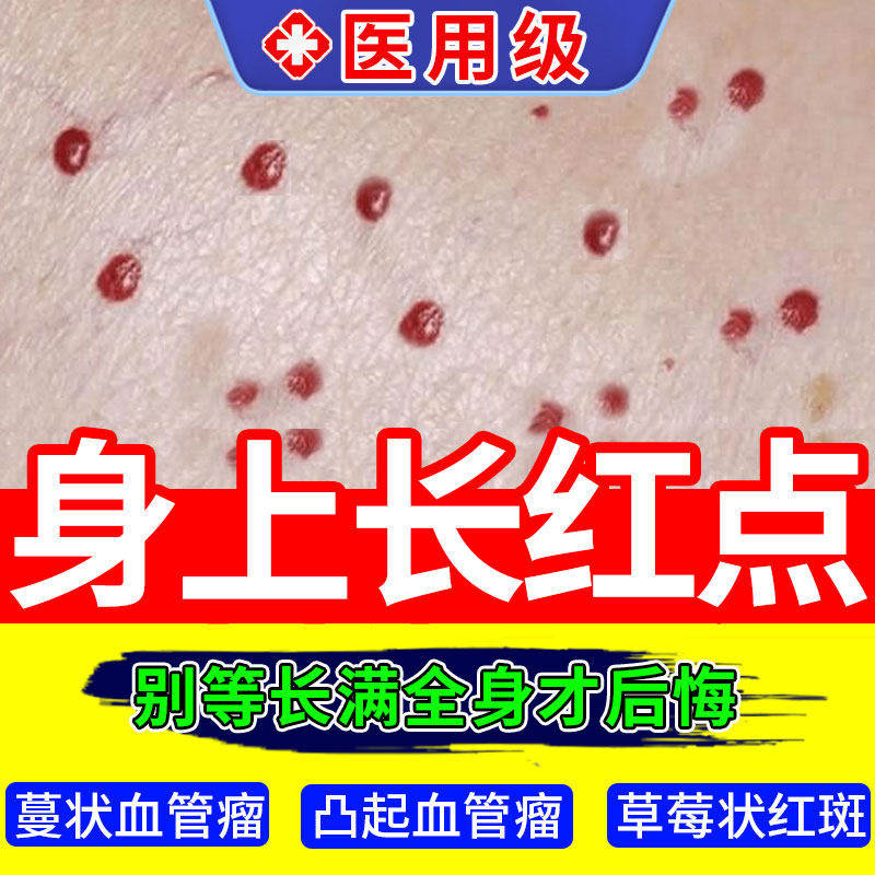 樱桃状血管瘤痣点红凝胶无