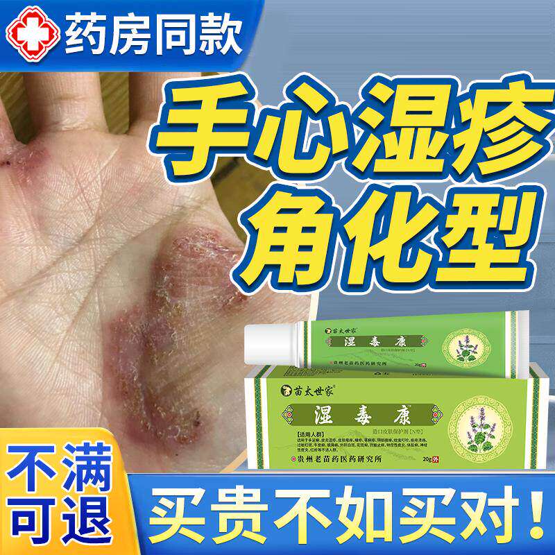 手心掌角化型湿疹止痒去上