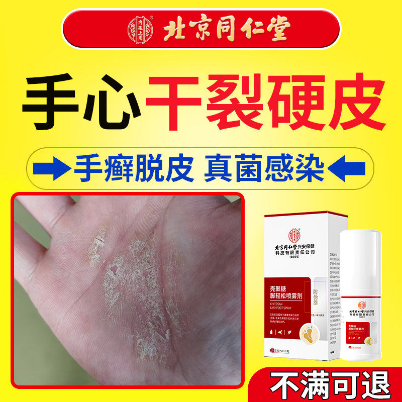 手癣膏脱皮干裂真菌感染足