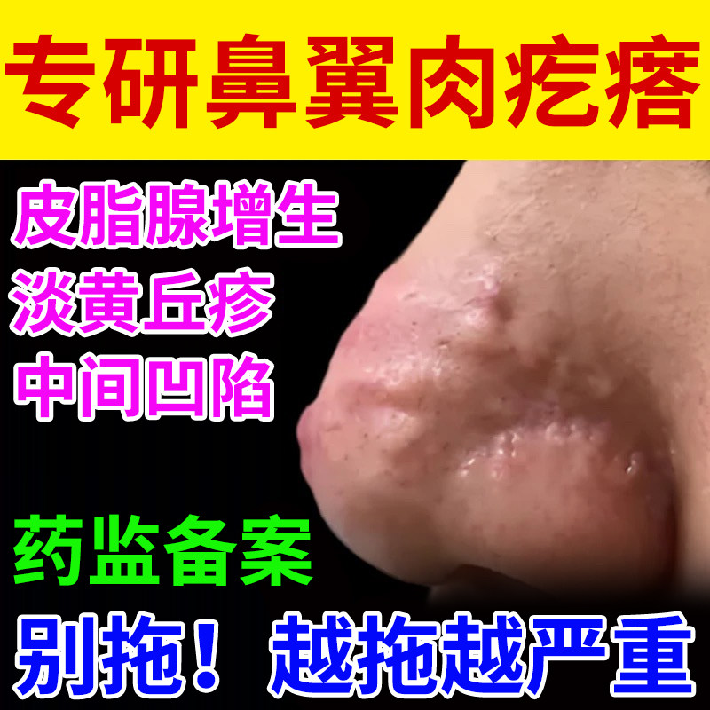 鼻翼子上肉疙瘩除头长消皮