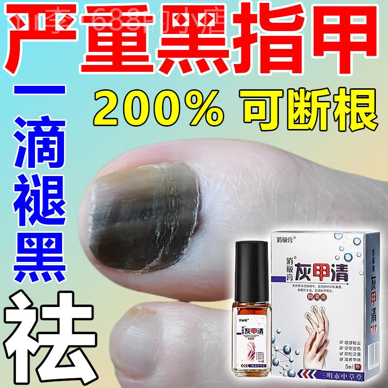 极速黑指甲药甲母痣手脚趾有淤血黑线分层厚黄T抑挤压变黑菌液