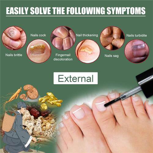 新品Naiul Fungal tCo uCJQre Nail Fungs Removal LiquidNuritio
