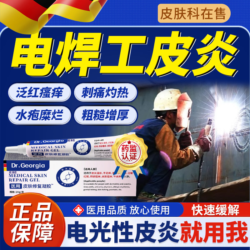 电焊工烤脸电光性皮炎软膏烫烤伤止痒红灼热刺挠痛二保焊弧光u9