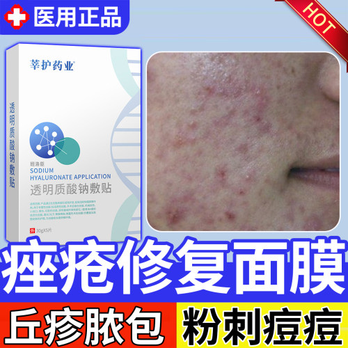 脸部痤疮面膜祛痘除玫瑰痤疮屏障痘痘医用修复消炎痘印毛囊炎u9