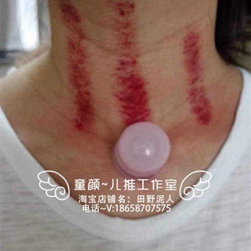 极速蜜芽花园太极平衡p硅胶罐小儿推拿刮痧拔罐宝宝专用允痧单罐