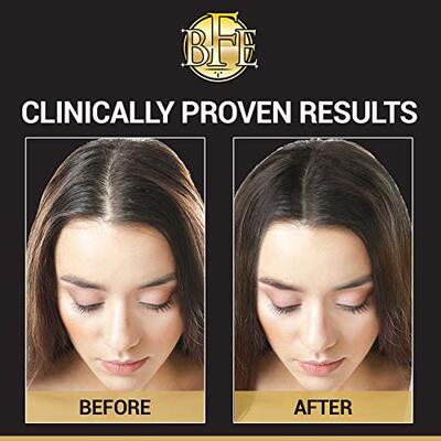 极速Hair Regrowth Serum- Maximum Strength MDHT Blocker. Repa
