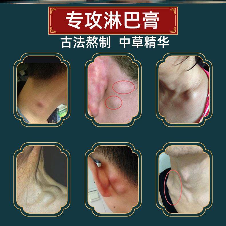 新品副乳消除贴腋下淋巴结u节解甲状腺消散结贴去冷敷凝胶疏通神