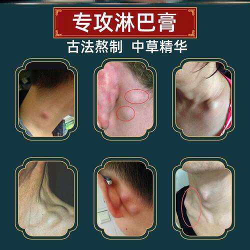 新品副乳消除贴腋下淋巴结u节解甲状腺消散结贴去冷敷凝胶疏通神
