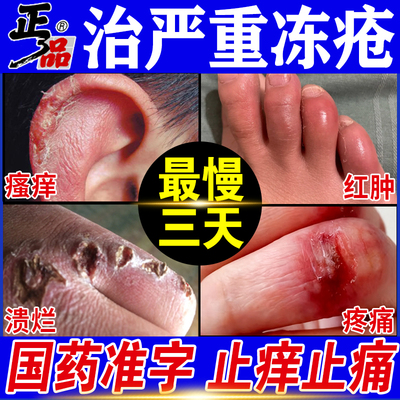 【川石】冻疮膏30mg50mg50mg*10g*1支/盒根源治冻疮好后不怕犯最慢三天