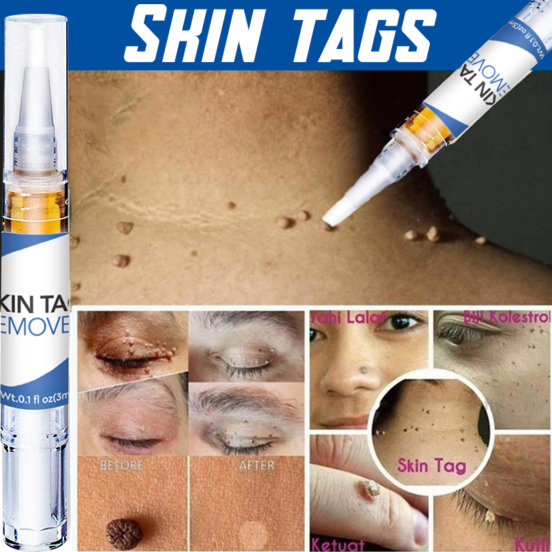 极速Skin Tag Remover Agat Moles 12 Hours Fast Removal ZGenit
