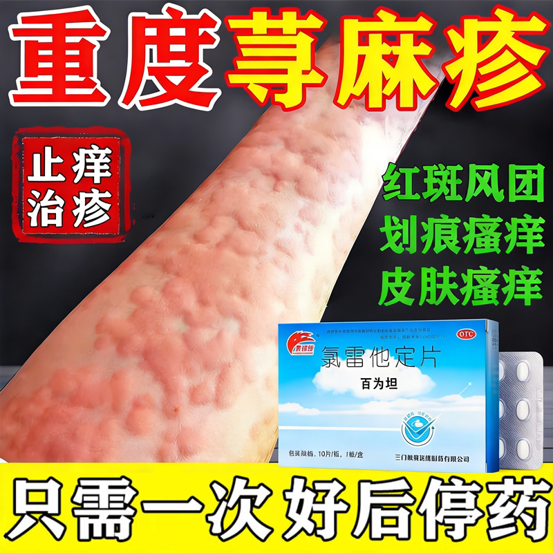 荨麻疹过敏止痒断专用药根专治皮肤痒的药慢性荨麻疹提高免疫力