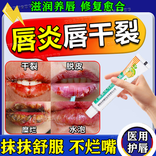 唇炎专用药膏嘴唇干裂脱皮医用型口角炎烂嘴角丁酸氢化可的松乳膏