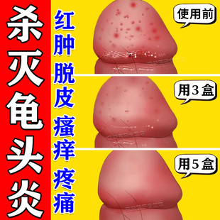 甲硝唑凝胶正品男性龟头炎真菌感染霉菌性包皮炎特药效开裂口红肿