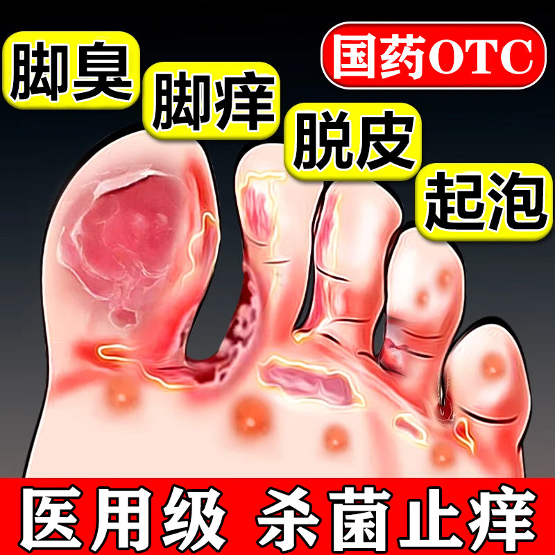 氢化可的松乳膏脚气专用特药效官方旗舰店烂脚丫脱皮糜烂脚趾