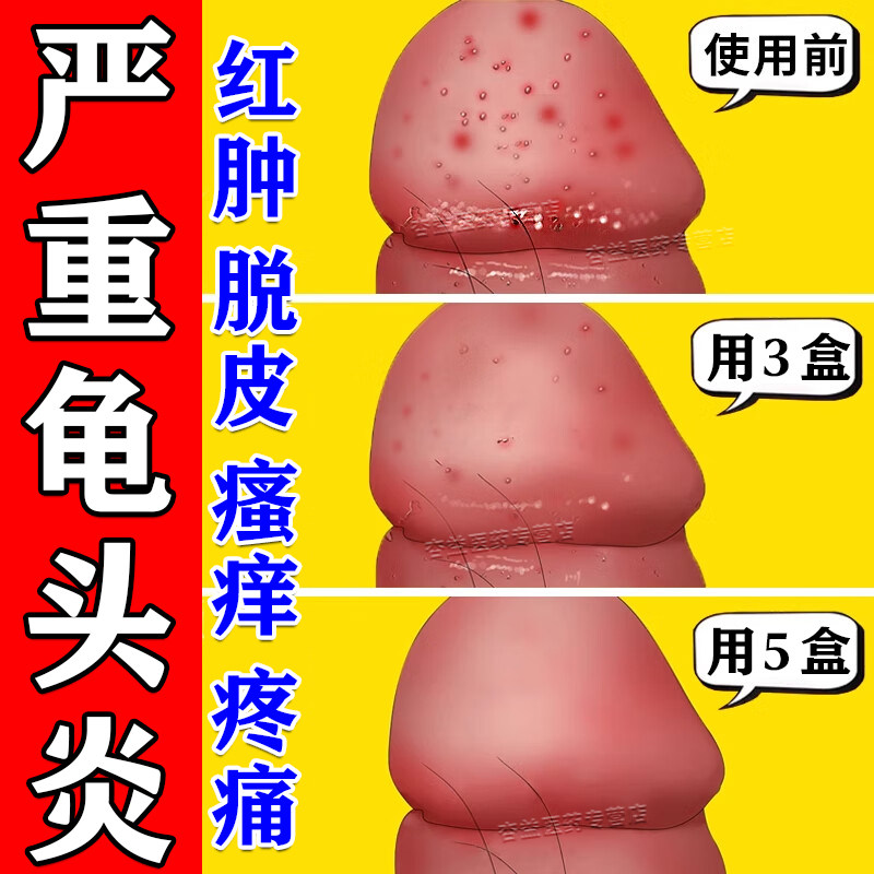甲硝唑凝胶正品男性龟头炎真菌感染霉菌性包皮炎特药效开裂口红肿