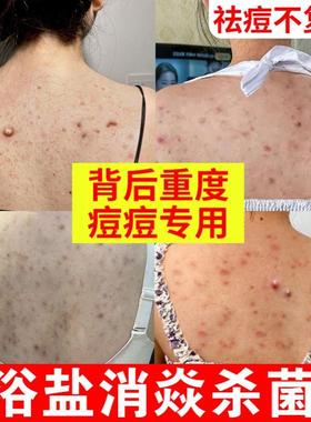 洗澡用的浴盐消杀菌炎止痒后背痘痘瘙痒牛奶沐浴盐去角质除螨
