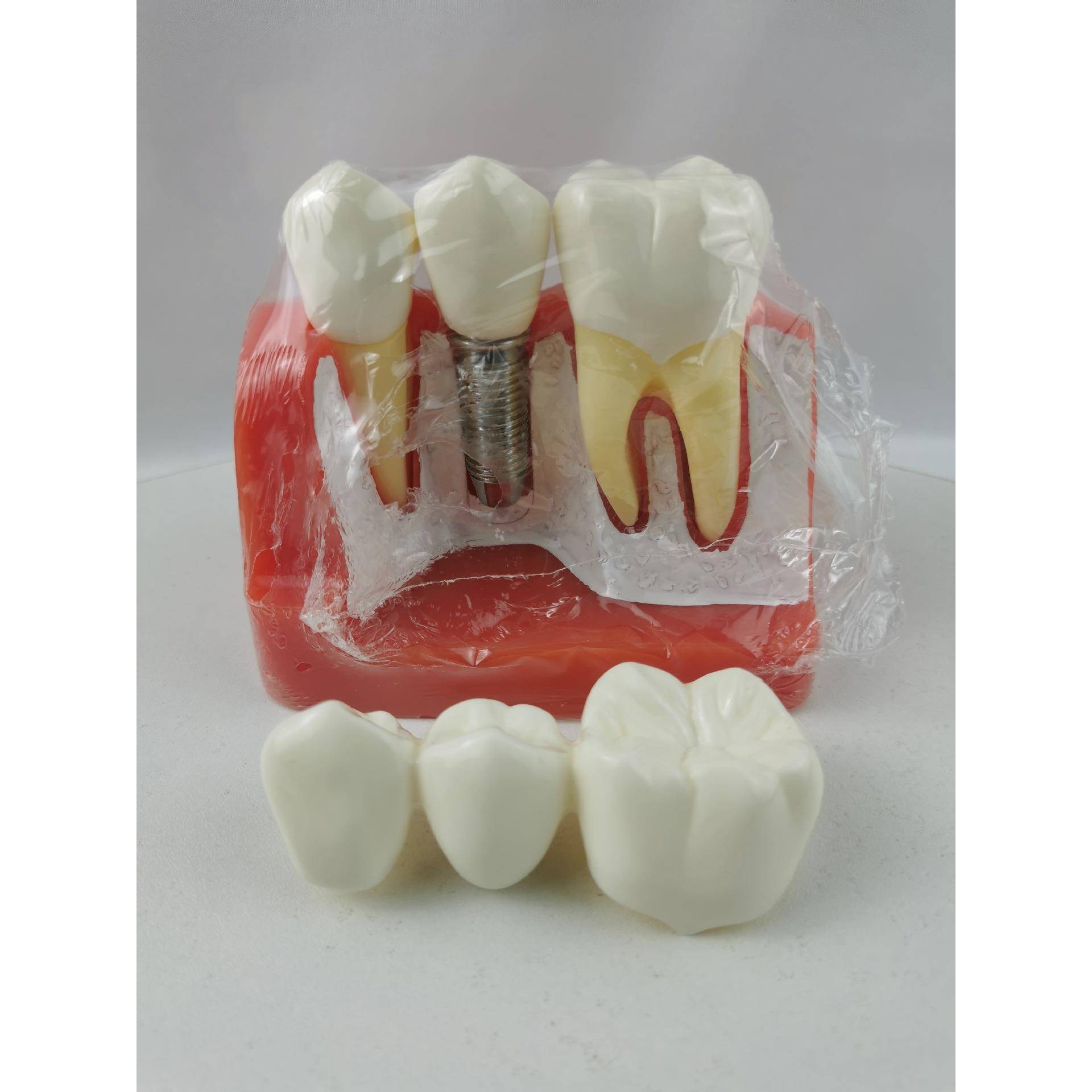 M2017R种植牙齿模型牙冠可分离