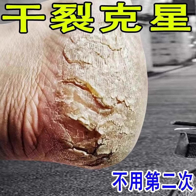 日本脚后跟干裂修复霜手足龟裂开裂皲裂治起皮去死皮润马油皱裂膏