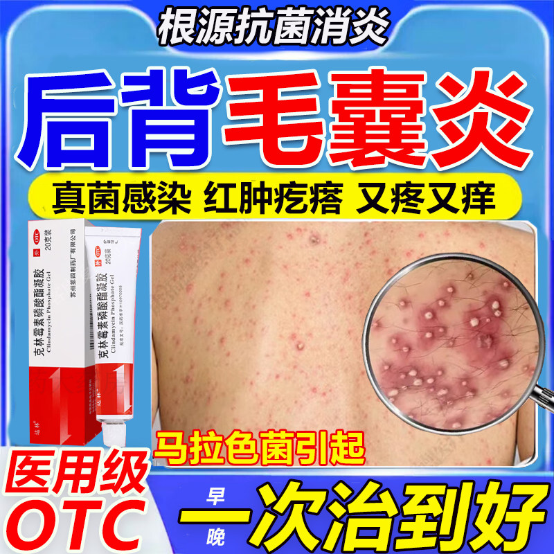 治疗毛囊炎专用药膏马拉色菌真菌细菌背上长痘痘毛囊炎除螨祛痘痒
