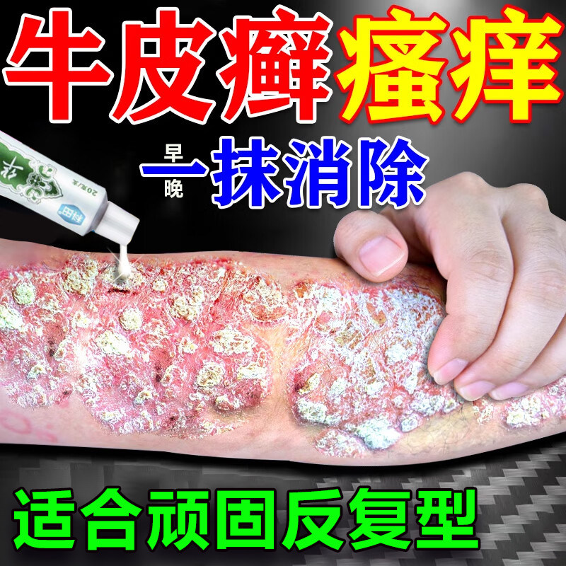 顽固牛皮癣银屑病专用药膏真菌感染体癣红斑鳞屑杀菌止痒去癣药膏