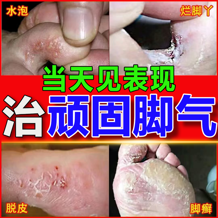 治脚气药止痒脱皮烂脚丫真菌感染根药治脚气脚臭特i效药严重水泡0