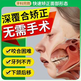 深覆合矫正器睡觉成人儿童牙齿不齐隐形咬合板下颌后缩牙套牵引器