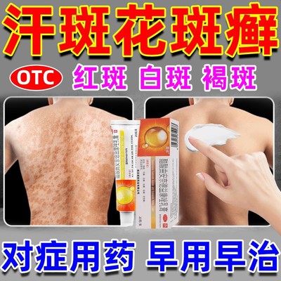 汗斑花斑癣专用药膏特新效药去体手股藓手癣体癣皮肤真菌感染止痒