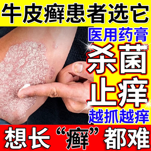 治疗牛皮癣银屑病专用药膏体癣真菌感染红斑鳞屑杀菌止痒