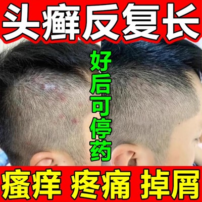 治头皮癣头皮屑脂溢性皮炎真菌感染头癣特新效药膏硝酸咪康唑乳膏