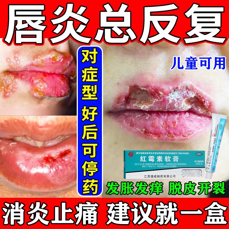 唇炎专用药膏嘴唇干裂脱皮红霉素软膏儿童成人嘴烂口角炎抗菌消炎