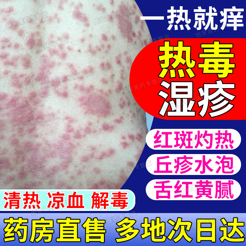 血热型湿疹特新效药皮肤红斑一热就痒止痒凉血解毒复方珍珠暗疮片