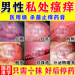 龟头炎症专用药膏男性私处瘙痒真菌感染包皮炎止痒硝酸咪康唑乳膏