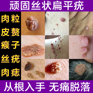 去除脖子腋下丝状疣皮赘头上小肉粒疙瘩瘊子寻常疣神器一抹灵无忧