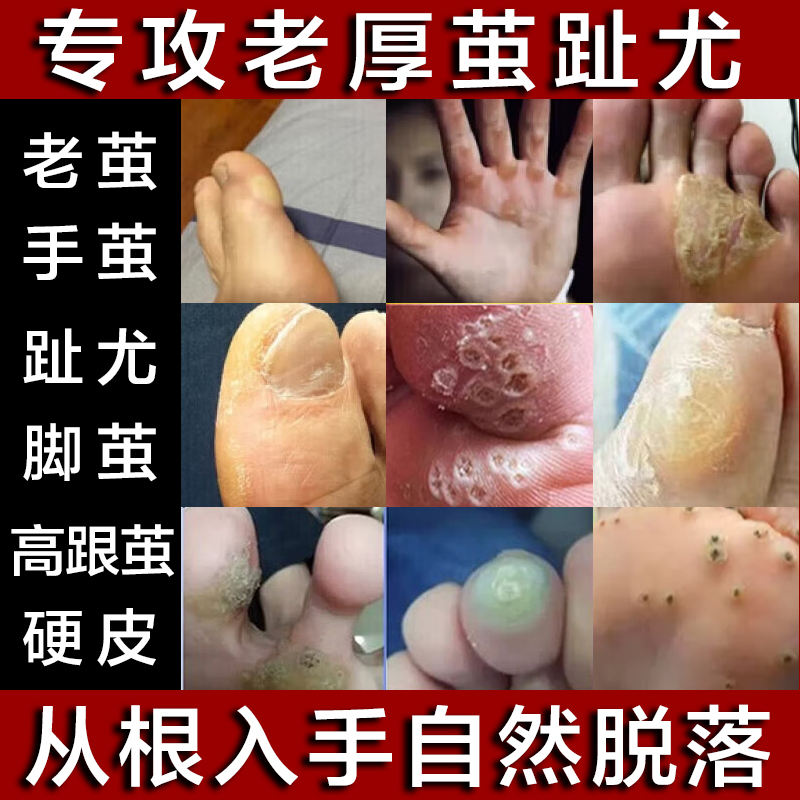 去手脚老茧硬皮不包不修无痛脱落