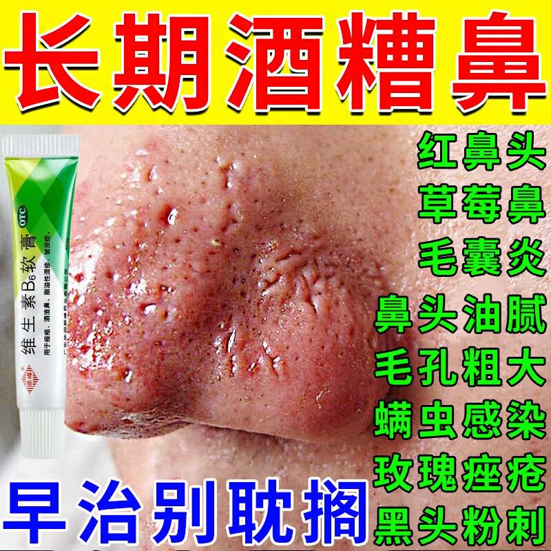 草莓鼻红鼻子酒渣鼻特药膏效头粉刺除螨虫痤疮鼻头油腻毛孔粗大 S