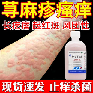 荨麻疹过敏止痒可用药水 外用湿疹止痒去痒根皮肤瘙痒过敏药疙瘩S