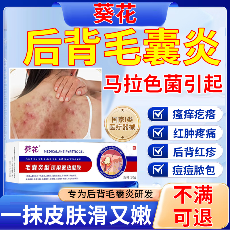 马拉色菌药毛囊炎 毛囊炎前胸后背