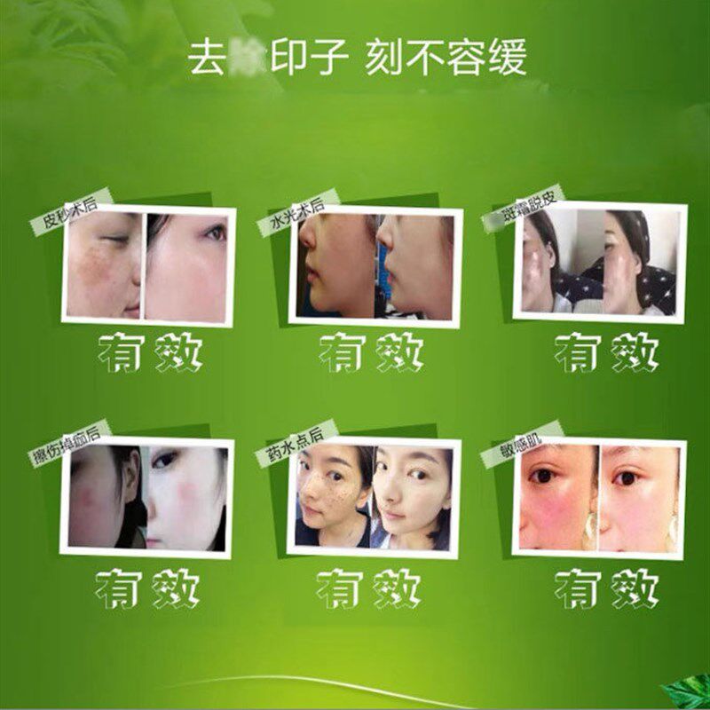 点斑修复膏正品修复因子激光点痣后修护液淡黑红印凹坑美容院专用