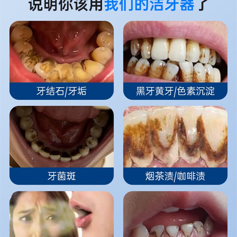 极速超声波洗牙器洁牙仪牙结石去除神器H洗牙齿污垢冲牙电动除牙