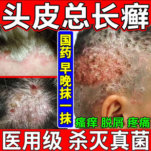 头癣药膏治头皮癣头部红斑瘙痒真菌感染结痂屑硝酸咪康唑乳膏正品