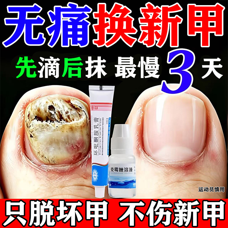灰指甲特专用根效药第部一名正品环吡酮胺乳膏官方旗舰店抗真菌