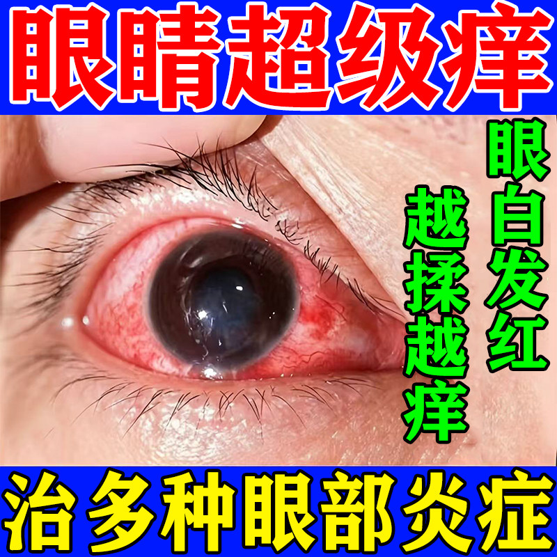 眼药水止痒消炎杀菌眼睛干涩疲劳滋润补水眼角痒抗过敏小支医用级