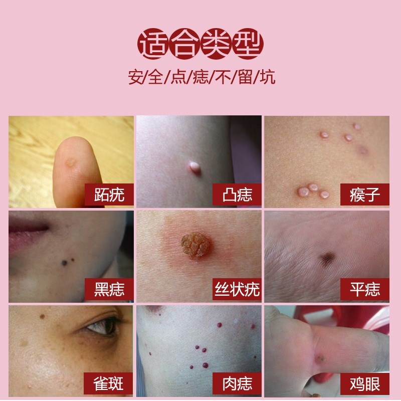 清赘抑菌膏液正品祛去痦子无痕痣膏除脸部点猴子去黑点黑痣肉痣